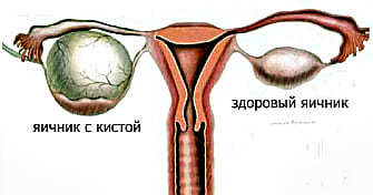 Можно ли забеременеть и рожать с кисточкой яичника: возможна ли беременность при эндометриоидной, фолликулярной и других кистах правого и левого яичника, лечение в Москве