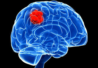 Ретроцеребеллярная киста головного мозга - симптомы, лечение