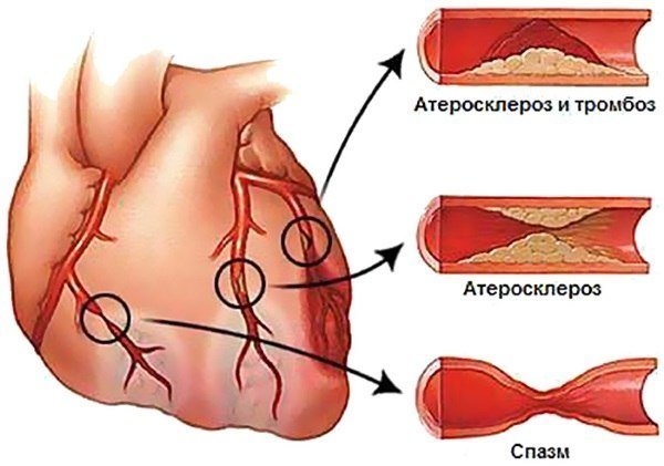 Последствия инфаркта у мужчин: причины, лечение