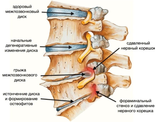 Боли в шее при повороте головы (справа или слева): что делать, чем лечить