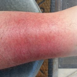 Аллергия на коже - красные пятна чешутся, лечение (фото)