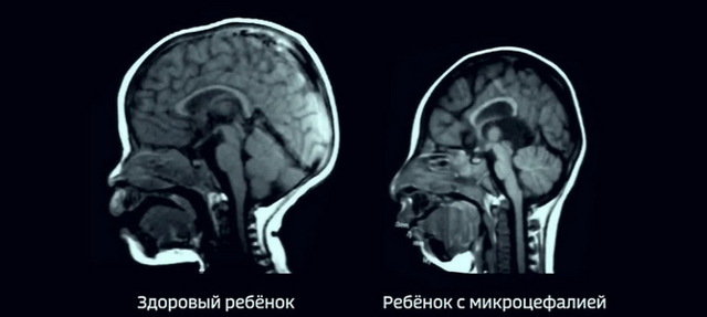 Микроцефалия у детей, симптомы и продолжительность жизни