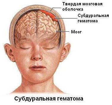 Субдуральная гематома головного мозга последствия