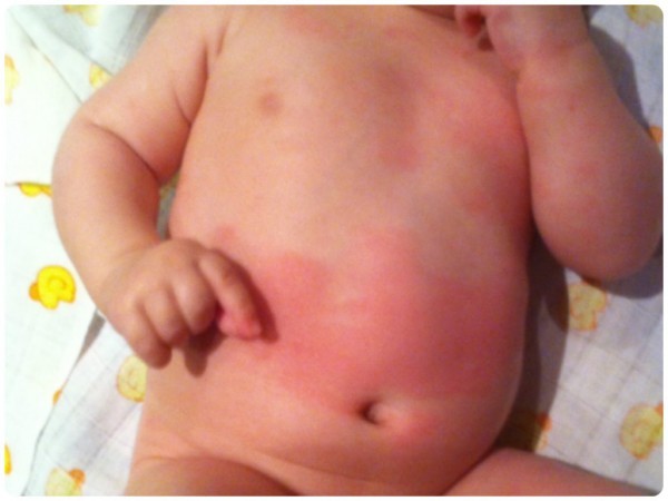 Красные пятна на животе у детей, беременных и взрослых - причины высыпаний и раздражения на коже