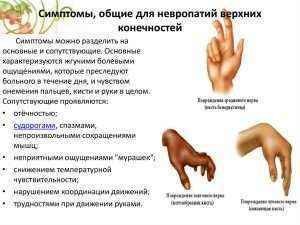 Невропатия лучевого нерва руки: симптомы и лечение