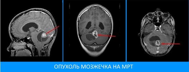 Опухоль мозжечка головного мозга - симптомы, прогноз и лечение