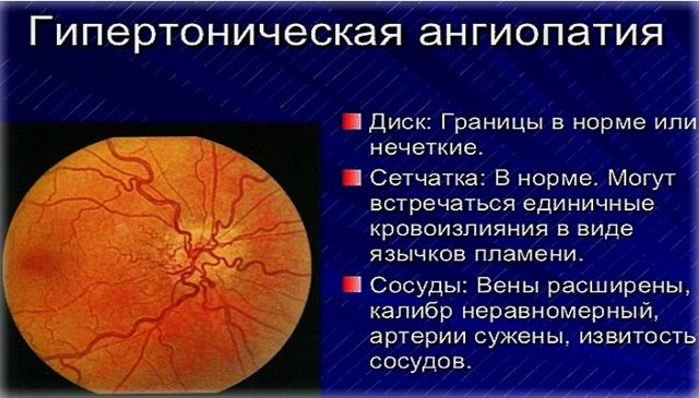Ангиопатия сетчатки глаза — что это такое и лечение