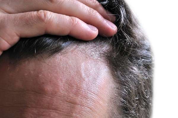 Шишки на голове в волосах: причины появления
