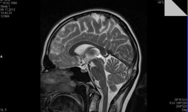 Чем опасна киста головного мозга в пожилом возрасте: головные боли и судороги