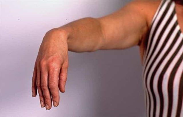 Невропатия лучевого нерва руки: симптомы и лечение