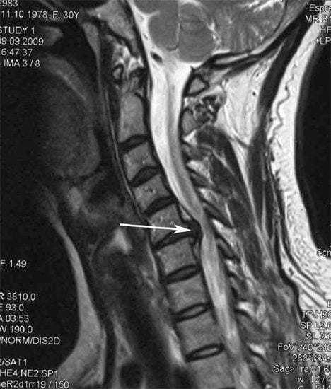 Боли в шее и плечах: причины и лечение сильной боли в мышцах