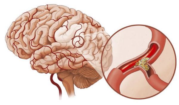 Атеросклероз сосудов головного мозга (церебральный атеросклероз) – симптомы, лечение, профилактика