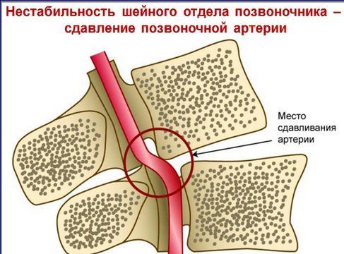 Почему после массажа шеи и воротниковой зоны болит голова? Что делать, если после массажа болит шея