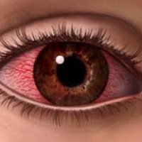 Дёргается глаз - причины, лечение и профилактика