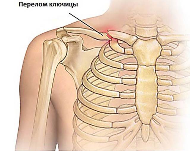 Плексит плечевого сустава: симптомы, диагностика и лечение