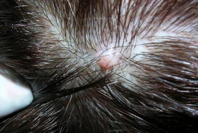 Папиллома на голове в волосах: фото, удаление, лечение