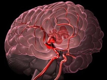 Субарахноидальное кровоизлияние в мозг: последствия, симптомы и лечение