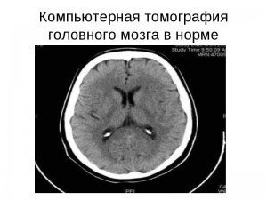 КТ головного мозга: что показывает томограмма и как делают обследование головы с контрастом?