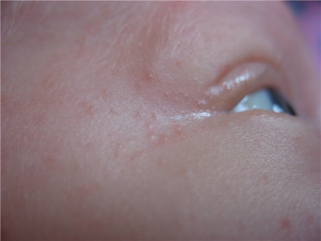Сыпь у ребенка (89 фото): виды детских инфекционных заболеваний с пояснениями, с мелкой красной или белой сыпью по всему телу, на локтях и груди, высыпания на коже
