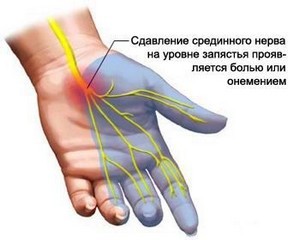Покалывание в пальцах рук левой руки: опасность симптома, причины и лечение