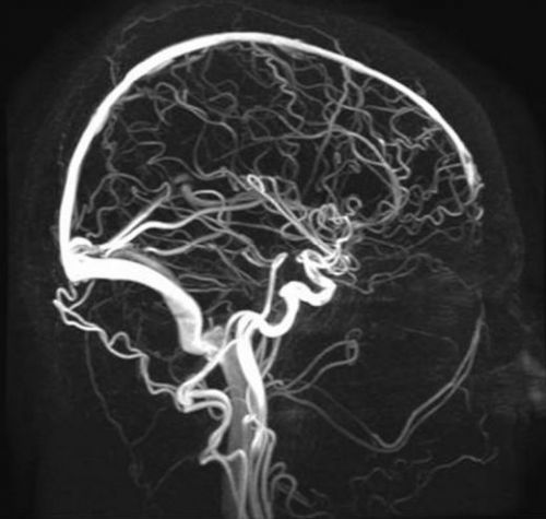 Церебральная ангиография сосудов головного мозга