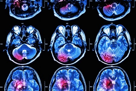Поражение головного мозга: причины и симптомы нарушения