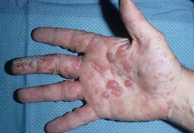Лечение экземы на руках (пальцах) народными средствами, мазями и кремами
