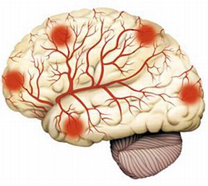 Классификация, симптомы и лечение сосудистых заболеваний головного мозга и ЦНС