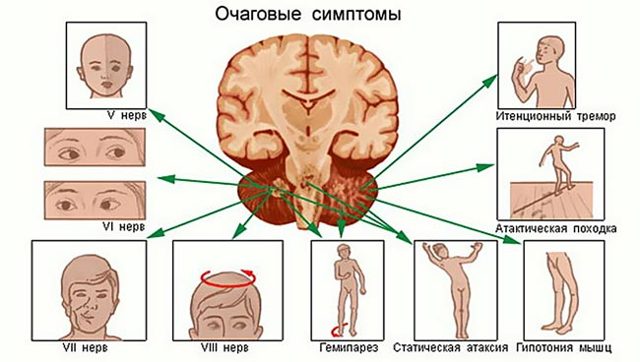 Опухоль мозжечка головного мозга - симптомы, прогноз и лечение