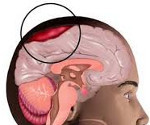 Субдуральная гематома головного мозга последствия