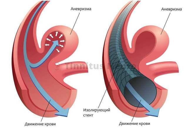 Аневризма сонной артерии (сосудов шеи): лечение, симптомы