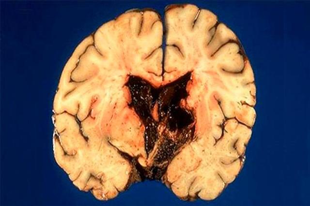 Кровоизлияние в желудках головного мозга: причины, симптомы, диагностика, лечение, профилактика