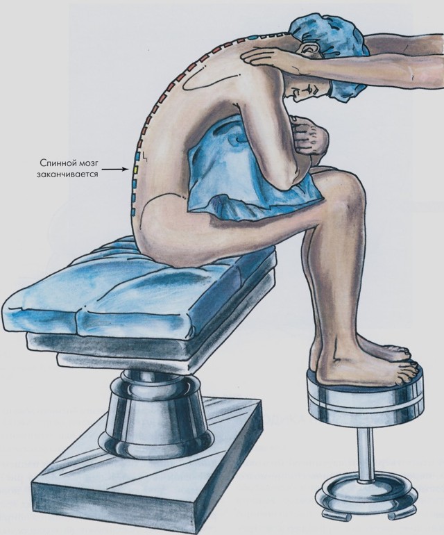 Спинальная анестезия - последствия и осложнения, техника проведения и противопоказания