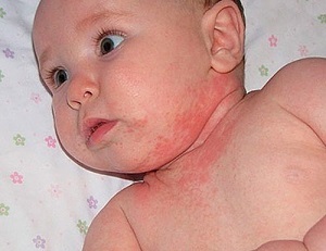 У ребенка чешется голова, шелушится кожа на голове у грудничка, новорожденного младенца, почему появилась сыпь, красные пятна, прыщики: что делать, причины зуда