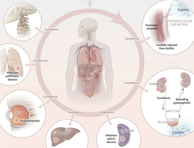 Грибок в организме человека: симптомы, признаки и лечение