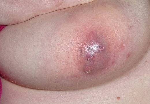 Фурункул на грудине у женщин: причины и лечение