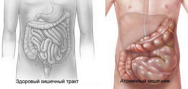 Атония кишечника – симптомы, лечение