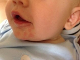 Раздражение вокруг рта у ребенка и взрослого: причины, лечение и профилактика