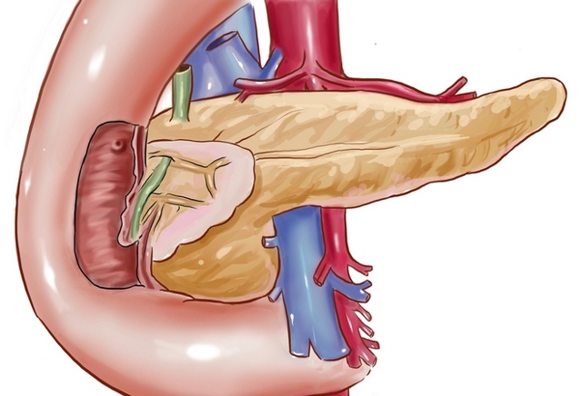 Диффузные изменения поджелудочной железы лечение