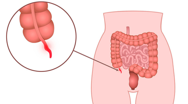 Может ли быть понос при аппендиците и как его лечить