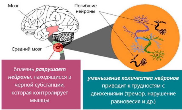 Общее и отличия Паркинсонизма и болезни Паркинсона