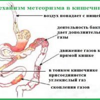 Метеоризм кишечника - причины, симптомы, лечение