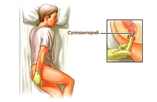 Свечи от геморроя, недорогие и эффективные при кровотечении: список лучших кровоостанавливающих суппозиториев, противовоспалительные геморроидальные средства