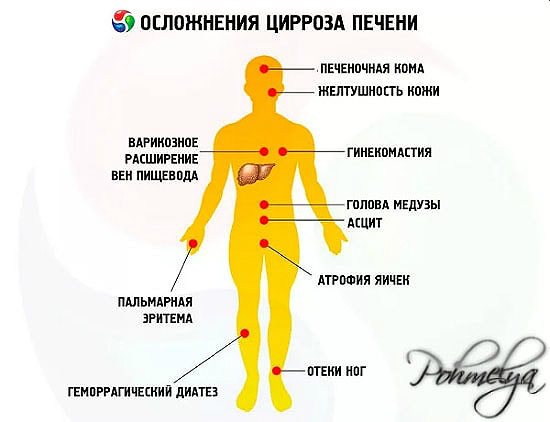 Симптомы цирроза печени у мужчин алкоголиков и лечение болезни