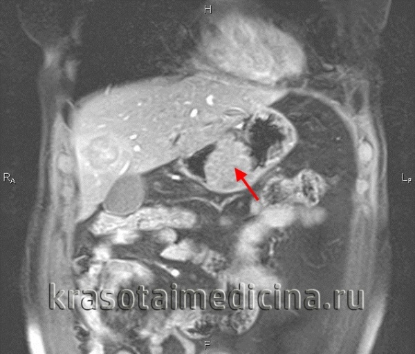 Рак желудка: первые симптомы и поздние признаки, лечение и прогноз