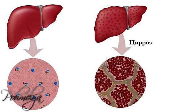 Симптомы цирроза печени у мужчин алкоголиков и лечение болезни