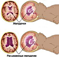 Внутренняя гипертензия головного мозга