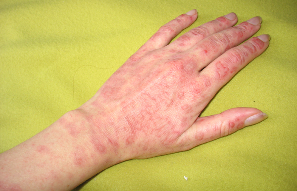 Аллергия на болгарский перец симптомы