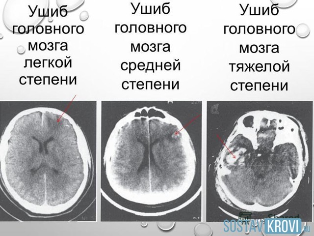 Ушиб головного мозга: причины, симптомы, степени, лечение