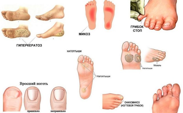 Патогенные грибы на коже, ногтях: лечение, исследование